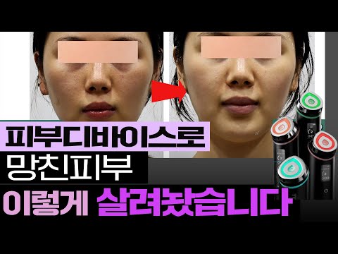 피부미용기기 좋다고 무조건 사용하면 피부 안 좋아지는 이유 & 실제 사례 소개/ 뷰티디바이스 부작용/ 뷰티디바이스 올바른 사용팁